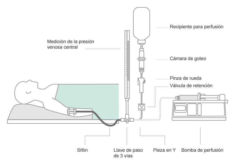Scheme of a parallel infusion configuration. Combinations of gravity infusion and pump driven infusion in parallel bears the risk of air embolism, when gravity infusion runs dry.