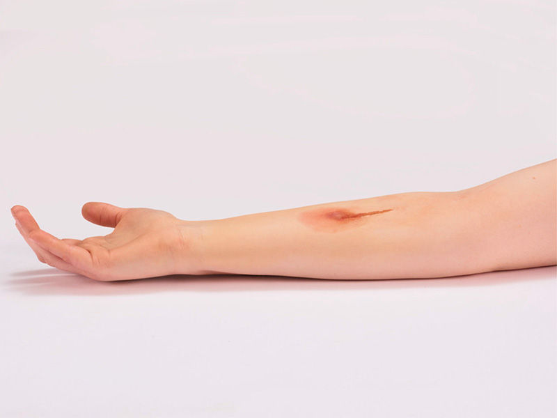Brazo derecho extendido con enrojecimiento alargado de la piel debajo del codo.