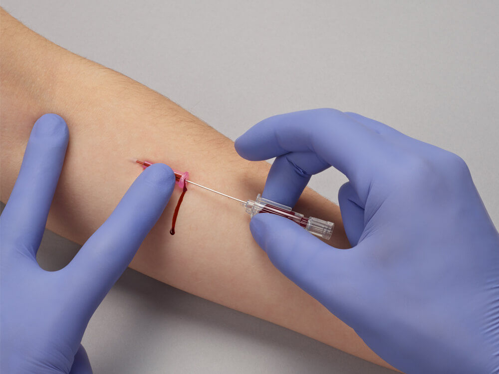 fuga de sangre durante la extracción de sangre