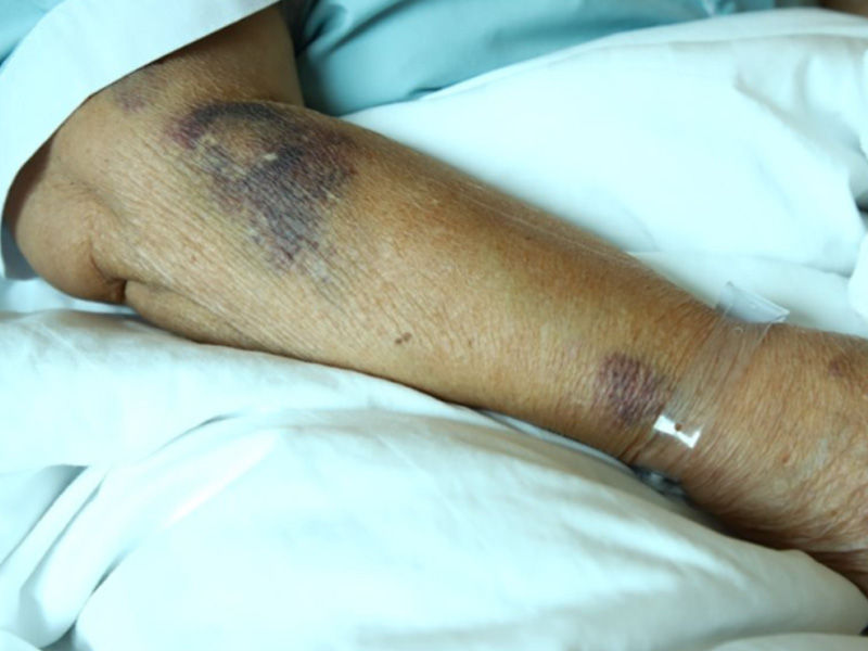 El brazo derecho con varios hematomas debajo del codo está tumbado sobre la colcha.