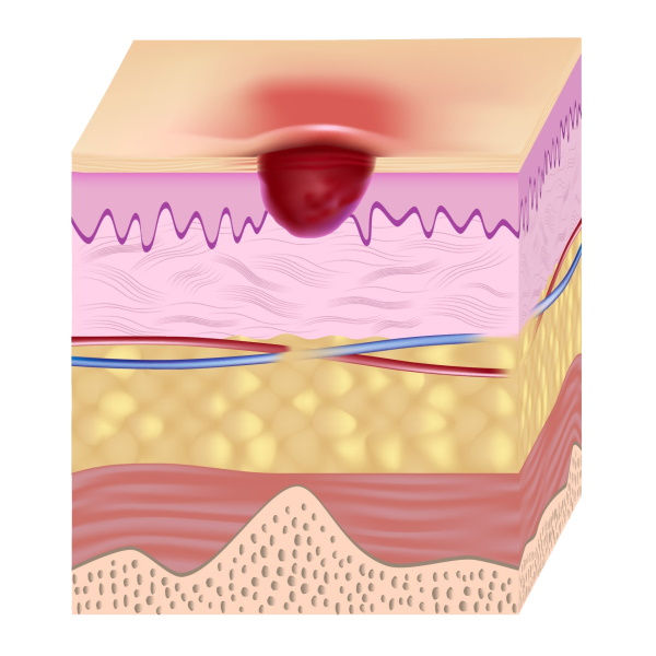 Ilustración : Úlcera por presión etapa 2