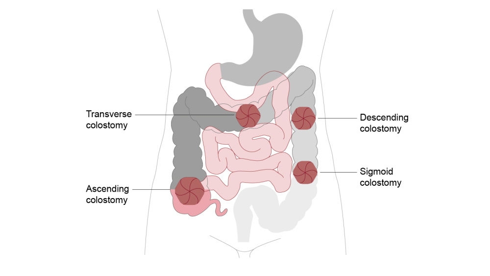 ilustración de colostomía transversal, descendente, ascendente y sigmoidea