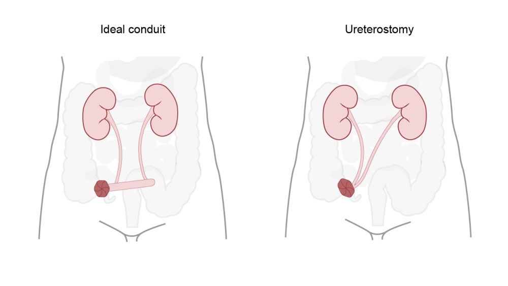 ilustración de los conductos ileales y la ureterostomía