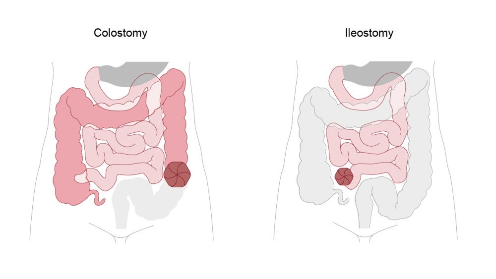 ilustración de colostomía e ileostomía