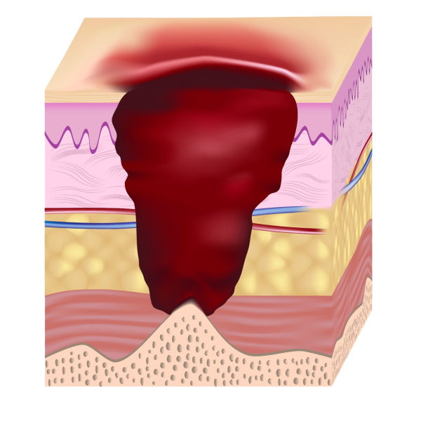 Ilustración : Úlcera por presión de grado 4