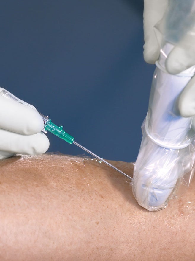 La mano con guante blanco sujeta la cánula verde en el brazo con gel transparente. La otra mano con guante blanco sostiene la sonda de ultrasonidos con cubierta protectora transparente fijada con un anillo de goma blanco.