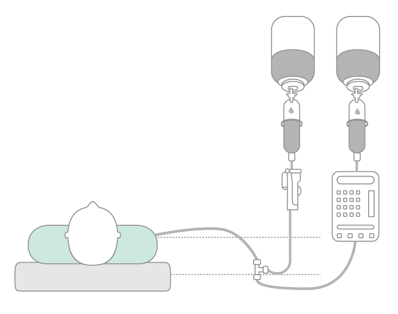 Parallel infusion with three-way valve of the bypass in ascending siphon tube.