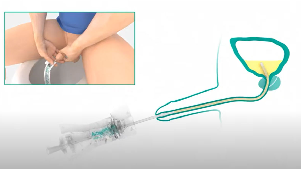 intermittent catheterization